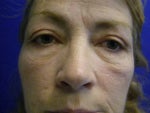 8 months after on my eyes
