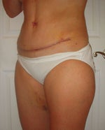 Also had inner thigh lipo, little brusing and swelling left