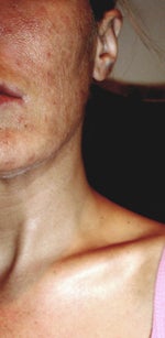 Two years after still have white lines and started getting open sores