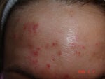Today 20 months after MTZ DNA DAMAGE
