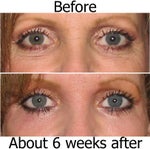 These photos are WITH makeup. The skin under my eyes are still BRIGHT pink, but the results so far are remarkable! The skin under my eyes were not this smooth in my early 30's. I'll update more as the healing continues.