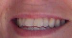 Before Invisalign