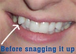 Before snagging it up with Invisalign