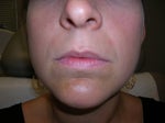 Before injections