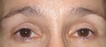 My eyes are very hollow due too much fat removed. 