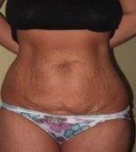 before tummy tuck surgery