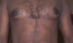 i look better before surgery, bit liposuction could have done better