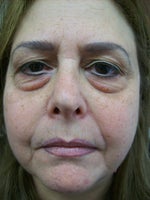 This is right before the first procedure....note the mouth area