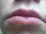lips the night before the injections