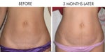 beforeafterbelly.jpg