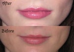 Four days after, a little uneven with some lower lip swelling and bruising.