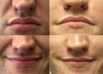 Before and after Radiesse NL FOLDS