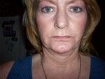 Update.....10 months post op. You can see the right side of my face is flat with the bulk sagging in the jowl area. I tipped my head slightly down to bring out the rings around my neck. You can see that the right side of my neck was pulled up more.