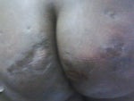 recovered butt from silicone injections