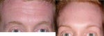 before and after botox