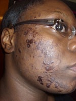 one day later no peeling just scarring (right side)