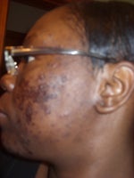 one day later no peelin just scarring(left side)