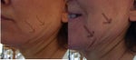 Creases and folds in  cheek, jaw and under chin