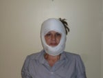 the new rooster look - day after surgery