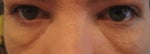 Dec15botheyes. Very bad swelling