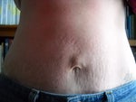 mini tummy tuck
