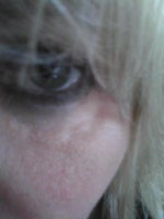 EVOLENCE EYE LUMPS