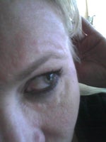 EVOLENCE EYE LUMPS