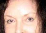 2 years after laser removal of most of tattooing.  It took months of laser, and they're still not completely gone!  My eyebrows still look odd and there's scarring. I have to cover leftover tattooing and scars with concealer.