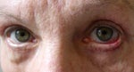 eyes after surgery,cropped.jpg