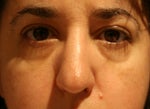 eyes post filler, believe it or not