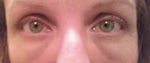 Here are my eyes now, 15 months post procedure
