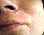 1st time peel- notice the thickness of the skin that is peeling off