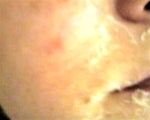 1st time peel-15%-5 days in