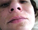 1st time peel. some of the peel got on my lips, as you can see they are peeling too.