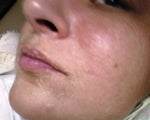 here is a good pic of how tight, dry and aligator like your skin will get.Skin has only began to peel around my mouth, not my cheeks or forehead.