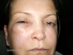 after radiesse 2 weeks later, face getting worse not better