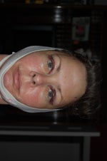 1 day post-op