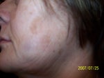Photo prior to any fraxel treatments