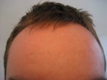Today, 1 month post. Scars diminished and better complexiton. Probably still some micro-swelling improving the look 