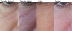 Fraxel II Progression