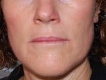 front - 1 year after