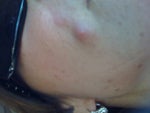 starting to abcess and drain
