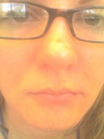 lips, 1cc restylane 1 week after
