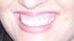 After veneers (4 front) and laser gum recontouring... still gummy