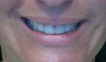 After Botox... Left side droopy