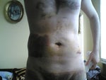 After laser liposuction