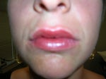 Immediately after injections