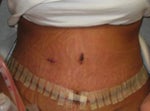 incision across bikini line