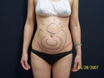 Before Smartlipo 