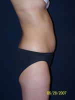 Before Smartlipo 